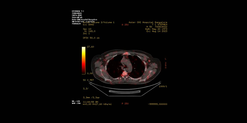 Abdominal Pain, Bloating and Jaundice